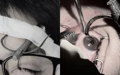 Nguy cơ mất thị lực do móc câu cá cắm vào mắt