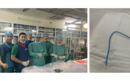 Ống thông truyền hóa chất bị bỏ quên suốt 3 năm, đứt trôi vào tim người phụ nữ