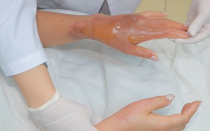 Bồn cầu phát nổ sau khi đổ hóa chất, người phụ nữ bỏng nặng