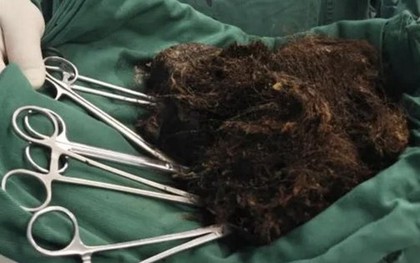 Người phụ nữ bụng "cứng như đá", bác sĩ phát hiện ra bí mật đáng sợ