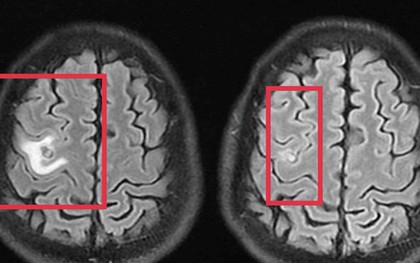 Người đàn ông 39 tuổi đau đầu, bác sĩ phát hiện thứ "đáng sợ" bên trong