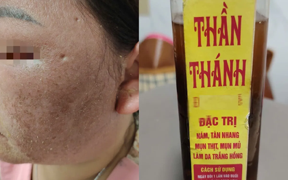 Cảnh báo nguy cơ tổn thương da do dùng "thuốc bôi thần thánh" trôi nổi