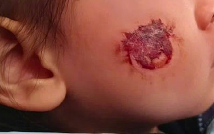 Bé gái 3 tuổi bị bỏng rộp cả mặt vì “miếng dán đồ chơi”: Nhiều đồ chơi hot trên mạng tuyệt đối không mua