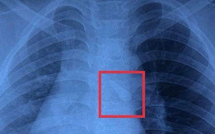 Gắp răng trong đường thở, cứu bé trai 10 tuổi sau tai nạn