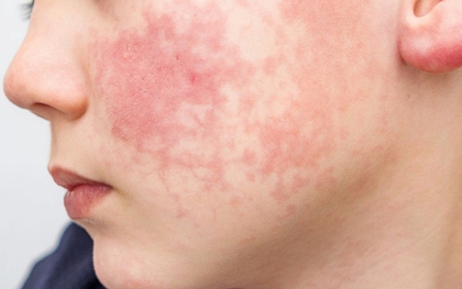 8 dấu hiệu ban đầu của "căn bệnh dễ lây lan nhất thế giới": Xuất hiện TRƯỚC cả khi phát ban, trẻ dưới 5 tuổi có nguy cơ cao nhất