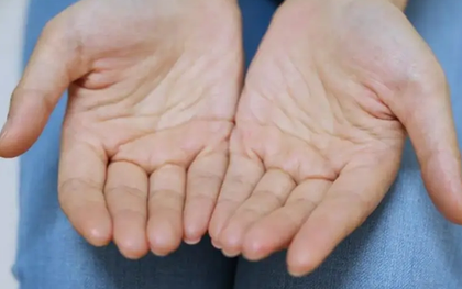 Nam giới mắc bệnh thận, thường xuyên ra mồ hôi ở 5 vị trí này