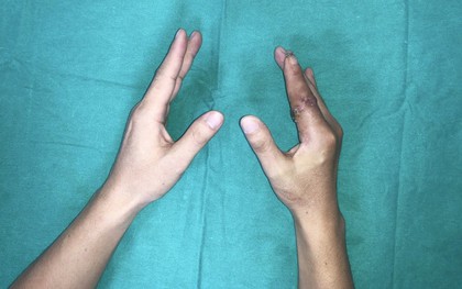 Ngón tay thủy thủ 'sống lại' sau 25 giờ đứt rời giữa tâm bão