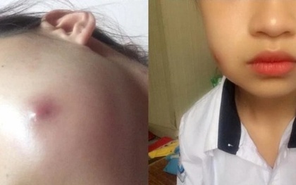 Bi hài chuyện "dao kéo" đổi vận: Mắc bẫy làm đẹp “lúm đồng tiền đổi đời”, cô gái nhận cặp má “ong đốt”