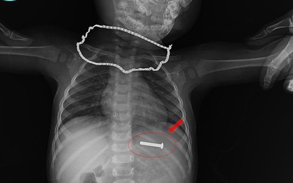 Đinh vít sắt dài 5cm trong dạ dày bé trai 15 tháng tuổi