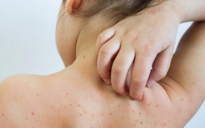 Một ca rubella vừa phát hiện: Bố mẹ chủ quan, trẻ lãnh hậu quả