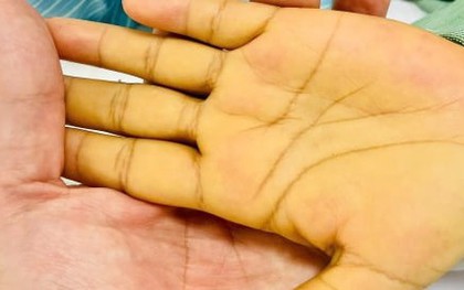 5 dấu hiệu nhận biết sớm ung thư gan không nên bỏ qua