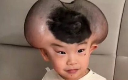 Nốt ruồi khổng lồ phủ kín hộp sọ khiến cậu bé có ngoại hình giống chuột Mickey
