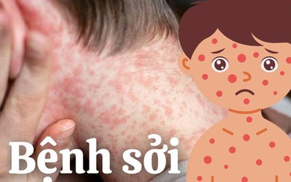 Bệnh sởi gia tăng: Nguy hiểm không phải chỉ với trẻ em
