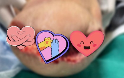 Giành giật sự sống từng giờ cho bệnh nhân ban đầu chỉ bị vết bỏng nhỏ ở chân: Ai mắc bệnh này hãy chăm sóc bàn chân thật cẩn thận!