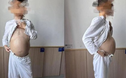 Người đàn ông 40 tuổi bụng to như mang bầu, khi phẫu thuật bác sĩ phát hiện điều đáng sợ