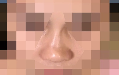 Sợ động dao kéo, nữ sinh nâng mũi bằng chỉ, 1 năm sau mũi biến dạng