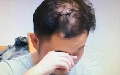 Nam sinh 16 tuổi đã hói nửa đầu vì 1 thói quen khi ngủ người càng trẻ tuổi càng dễ “sa vào bẫy”