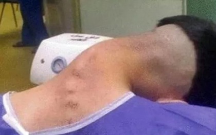Nam thanh niên 23 tuổi mắc 'hội chứng đầu gục' do lạm dụng chất gây nghiện kéo dài