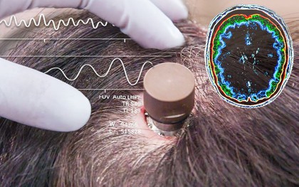 Người đàn ông bị liệt chỉnh sửa video, đăng YouTube 'chỉ bằng suy nghĩ': Ca cấy chip não Neuralink thứ ba gây chấn động