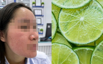 Dùng nước chanh trị mụn theo trên mạng, cô gái trẻ "hỏng mặt"
