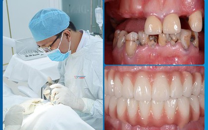 Tiêu chân răng là gì? Phân loại và cách điều trị