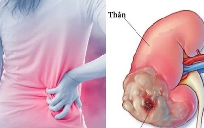Dấu hiệu thầm lặng cảnh báo ung thư thận