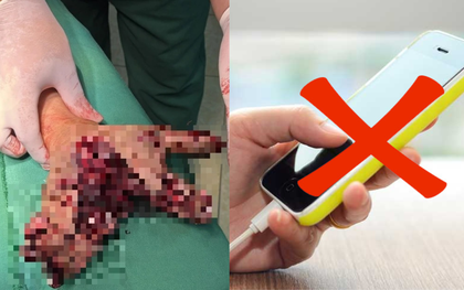 Vừa sạc pin vừa dùng điện thoại, người đàn ông Điện Biên bị chẻ đôi bàn tay