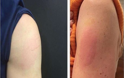 Tiêm vắc xin HPV có phản ứng phụ nào không, khi nào cần gặp bác sĩ?