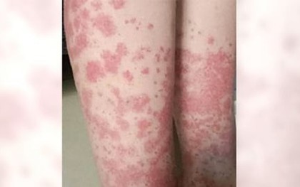 Nữ sinh trả giá đắt vì nhuộm tóc liên tục: Thận chảy máu, phải cạo đầu giữ mạng