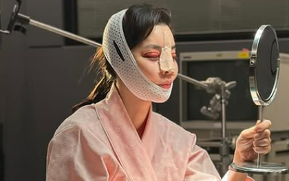 Mỹ nhân Giày Thủy Tinh gây sốc với gương mặt sưng tấy đáng sợ, băng bó kín mít