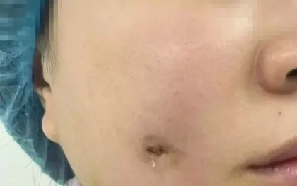 Người phụ nữ bị nhiễm trùng sau khi làm má lúm đồng tiền