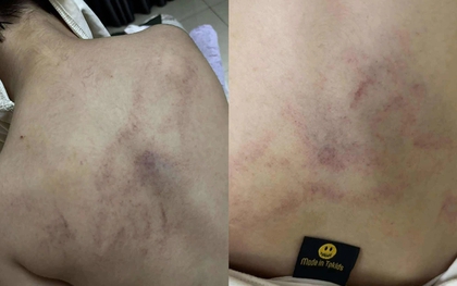Bé gái mầm non nghi bị bạo hành, đánh tím lưng tại Hà Nội: Gia đình bàng hoàng khi biết lý do
