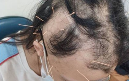 Đột nhiên tóc rụng từng mảng tới "hói trắng cả đầu", nữ sinh bàng hoàng khi nghe bác sĩ tiết lộ nguyên nhân