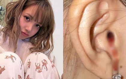 "Máu nhỏ giọt từ tai tôi", tiết lộ của Lisa (BlackPink) khiến nhiều người lo lắng: Chuyên gia chỉ ra nguyên nhân