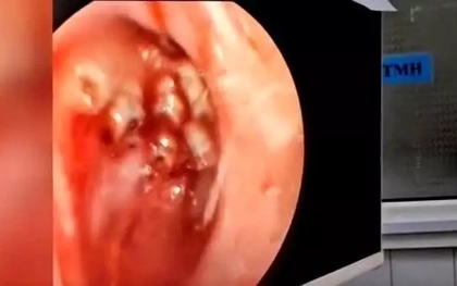 Dòi đóng ổ trong mũi người phụ nữ