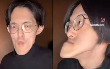 Người đàn ông có "chiếc cằm dài nhất thế giới", vẫn tiếp tục dài ra