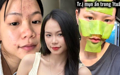 Trị mụn ẩn, thâm mụn trong 1 tuần, cô nàng dùng chiêu đơn giản đến không ngờ