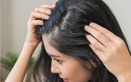 Viên uống chống già giúp xóa nếp nhăn nhưng gây rụng tóc khi dùng sai liều lượng