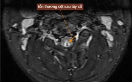 Hít 50 quả bóng cười mỗi lần suốt hơn 1 năm, nam thanh niên 20 tuổi tổn thương tủy sống