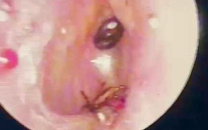 Nội soi tai bé trai 9 tuổi, bác sĩ phát hiện điều đáng sợ
