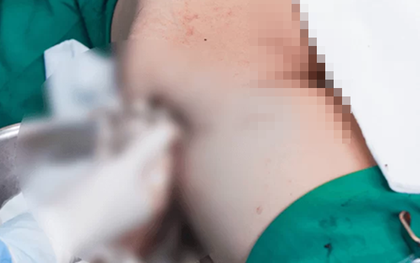 Tiêm 1.000ml filler giả vào mông, cô gái nhập viện hút ra 3.000ml dịch hoại tử