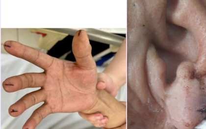 Chích máu đầu ngón tay cứu đột quỵ: Cứu người hay rước họa?