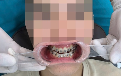 Trầm cảm vì niềng răng 3 năm vẫn "hô như ngày đầu"