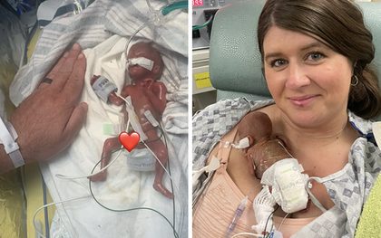 Em bé "sinh non nhất thế giới" nặng 285 gam, dài 24cm khi mới chào đời, sau 1 năm giờ ra sao?