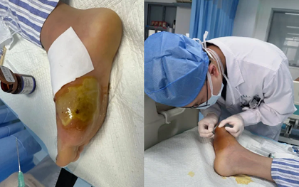 Suýt mất cả bàn chân vì giẫm phải cây tăm