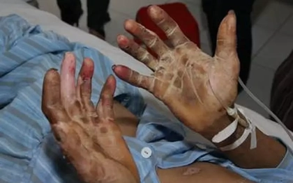 Xẻ thịt lợn không đồ bảo hộ, người đàn ông đối mặt nguy cơ mất thính lực suốt đời