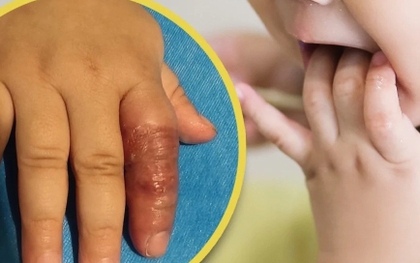 Mẹ dùng băng quấn để ngăn con mút tay, em bé suýt phải cắt cụt ngón