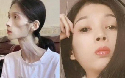 Số phận bi thảm của cô gái xinh đẹp biến thành 'bộ xương di động' 17kg