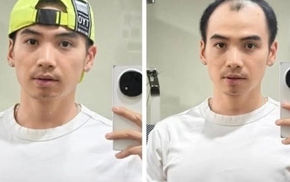 Chồng H'Hen Niê thay đổi thế nào sau cấy tóc trị hói đầu? Phương pháp này có giá bao nhiêu?