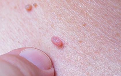 4 loại bệnh ngoài da do nhiễm HPV, tiêm vắc xin HPV liệu có phòng được hết?